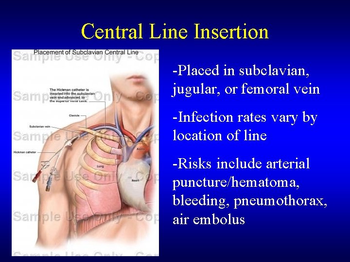Central Line Insertion -Placed in subclavian, jugular, or femoral vein -Infection rates vary by