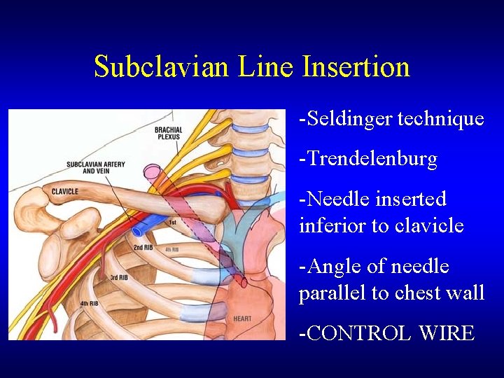 Subclavian Line Insertion -Seldinger technique -Trendelenburg -Needle inserted inferior to clavicle -Angle of needle
