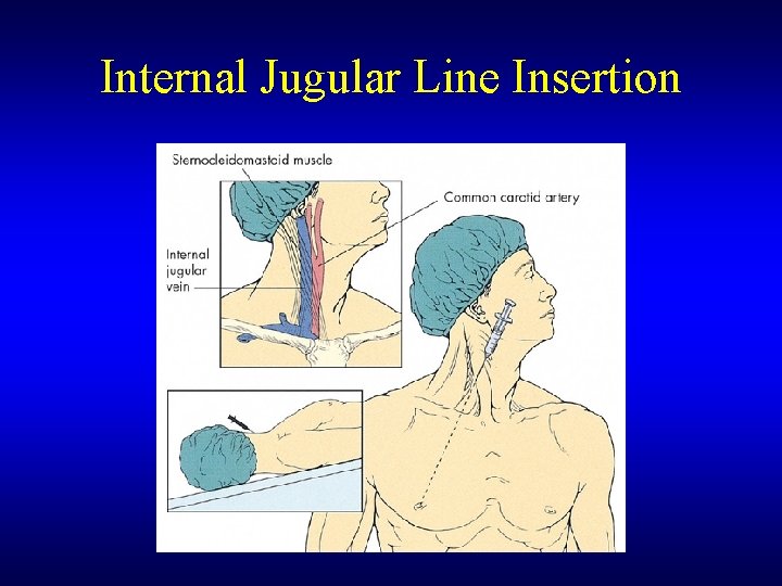 Internal Jugular Line Insertion 