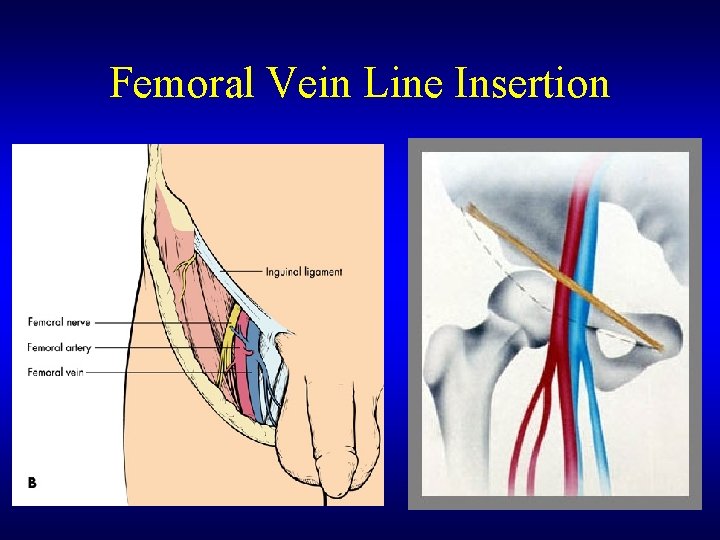 Femoral Vein Line Insertion 