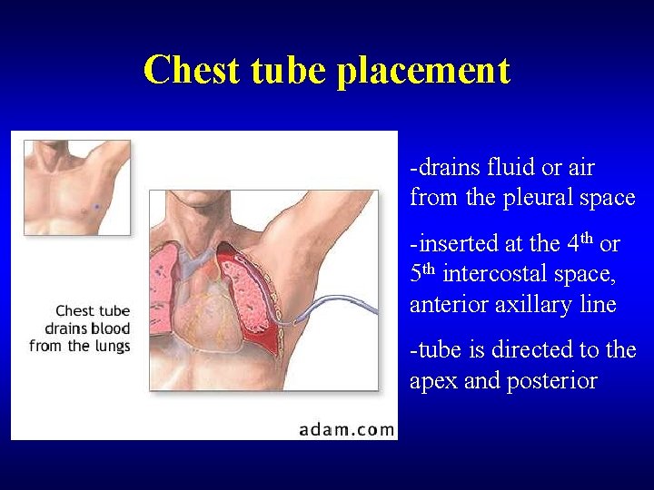 Chest tube placement -drains fluid or air from the pleural space -inserted at the