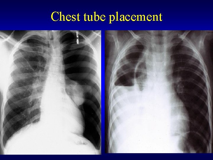 Chest tube placement 