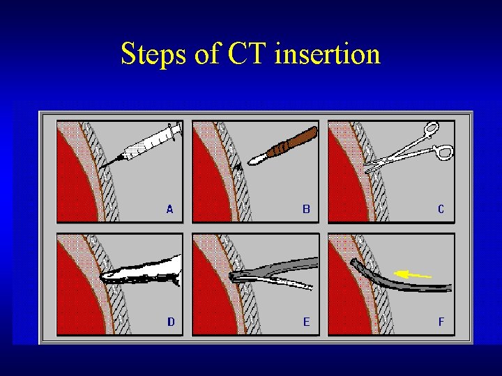 Steps of CT insertion 