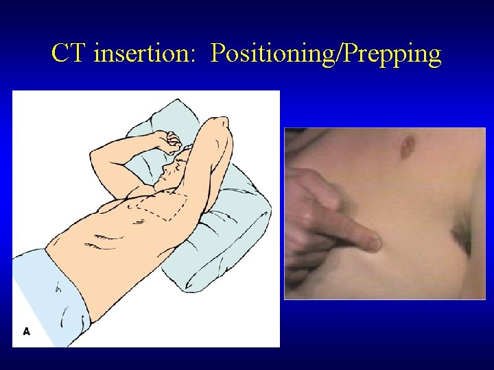 CT insertion: Positioning/Prepping 