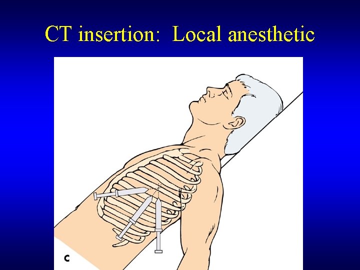 CT insertion: Local anesthetic 