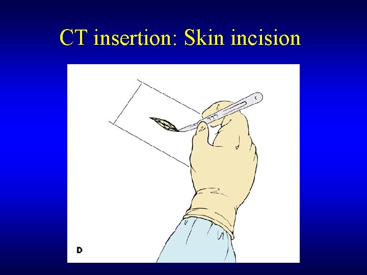 CT insertion: Skin incision 