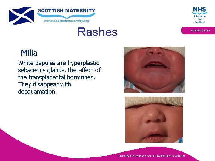 Rashes Multidisciplinary Milia White papules are hyperplastic sebaceous glands, the effect of the transplacental