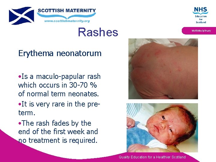 Rashes Multidisciplinary Erythema neonatorum • Is a maculo-papular rash which occurs in 30 -70