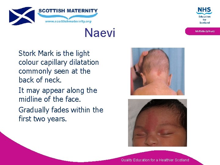 Naevi Multidisciplinary Stork Mark is the light colour capillary dilatation commonly seen at the