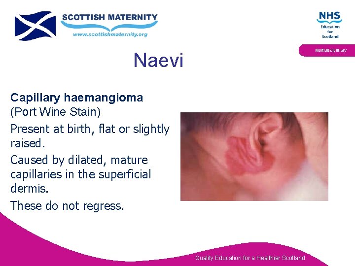 Multidisciplinary Naevi Capillary haemangioma (Port Wine Stain) Present at birth, flat or slightly raised.