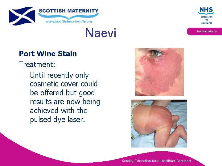 Naevi Multidisciplinary Port Wine Stain Treatment: Until recently only cosmetic cover could be offered