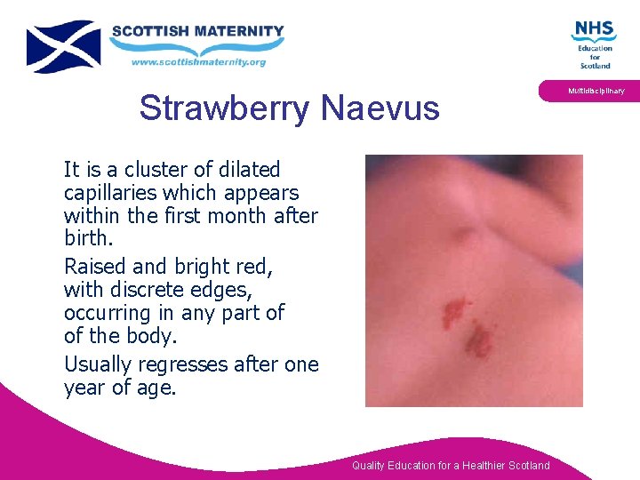 Strawberry Naevus It is a cluster of dilated capillaries which appears within the first