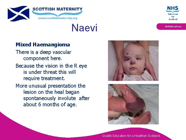 Naevi Multidisciplinary Mixed Haemangioma There is a deep vascular component here. Because the vision