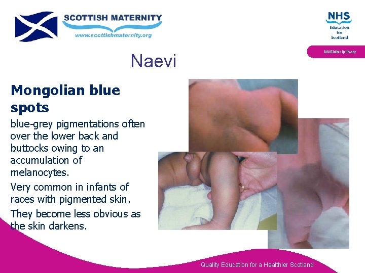 Multidisciplinary Naevi Mongolian blue spots blue-grey pigmentations often over the lower back and buttocks