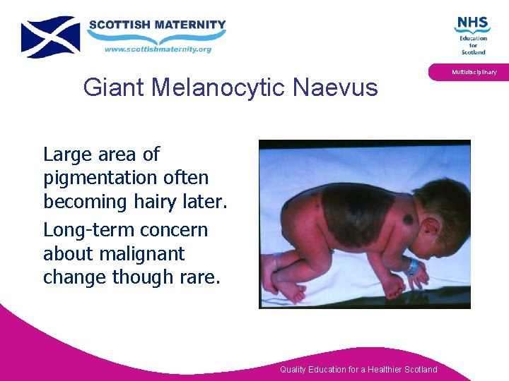 Giant Melanocytic Naevus Large area of pigmentation often becoming hairy later. Long-term concern about