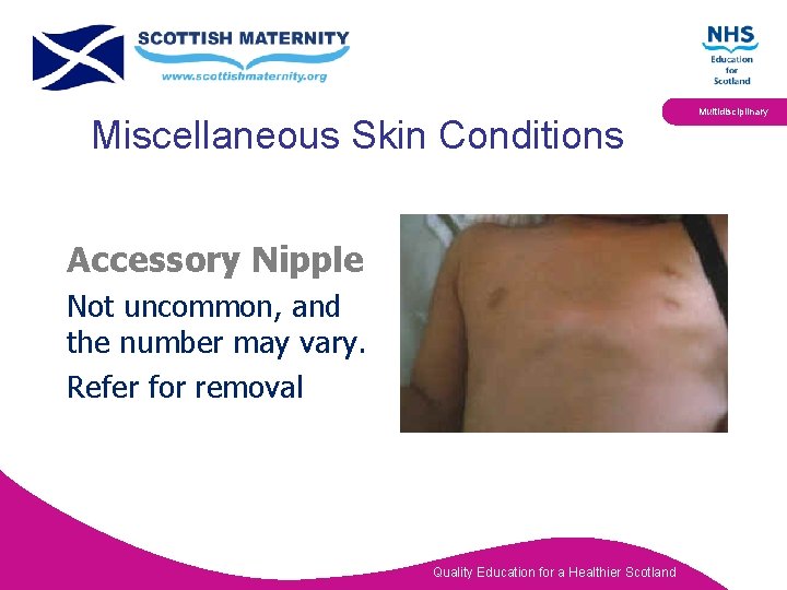 Miscellaneous Skin Conditions Accessory Nipple Not uncommon, and the number may vary. Refer for