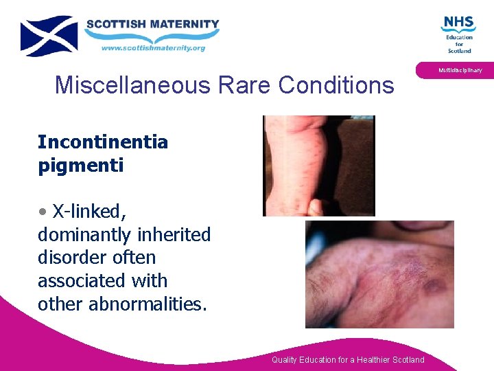 Miscellaneous Rare Conditions Incontinentia pigmenti • X-linked, dominantly inherited disorder often associated with other