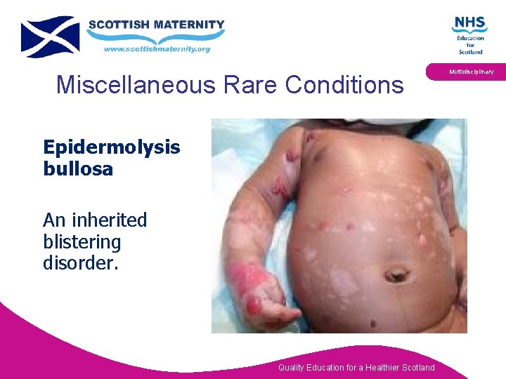 Miscellaneous Rare Conditions Epidermolysis bullosa An inherited blistering disorder. Quality Education for a Healthier