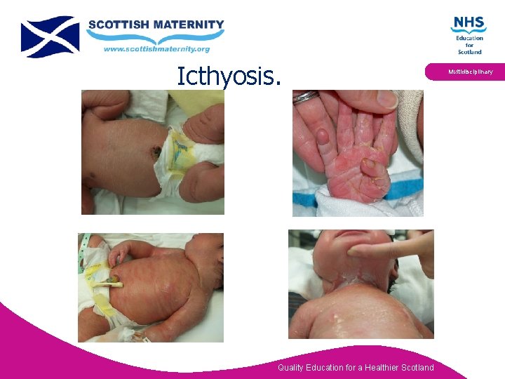 Icthyosis. Quality Education for a Healthier Scotland Multidisciplinary 