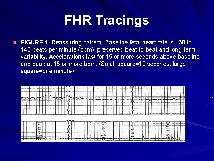 FHR Tracings FIGURE 1. Reassuring pattern. Baseline fetal heart rate is 130 to 140