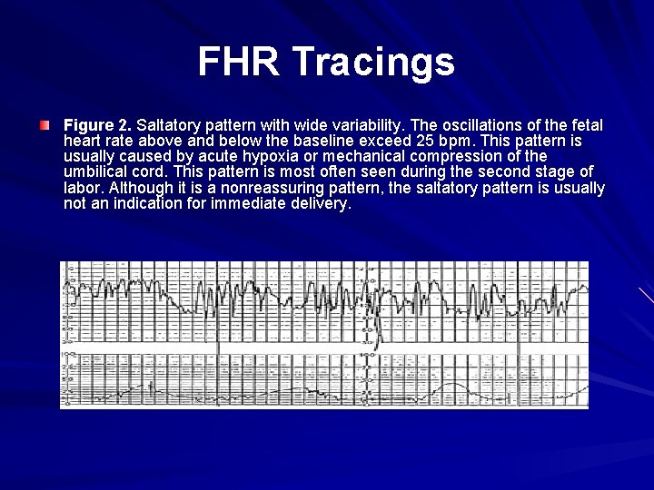 FHR Tracings Figure 2. Saltatory pattern with wide variability. The oscillations of the fetal