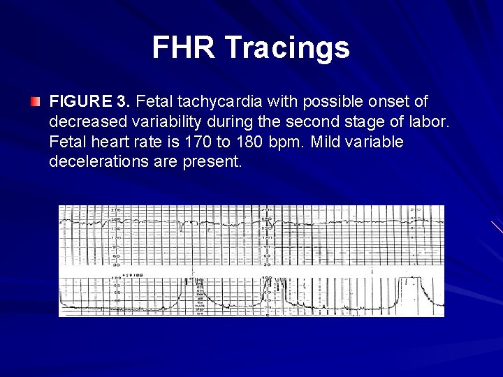 FHR Tracings FIGURE 3. Fetal tachycardia with possible onset of decreased variability during the
