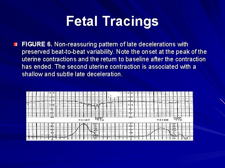 Fetal Tracings FIGURE 6. Non-reassuring pattern of late decelerations with preserved beat-to-beat variability. Note