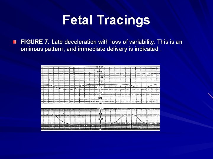 Fetal Tracings FIGURE 7. Late deceleration with loss of variability. This is an ominous