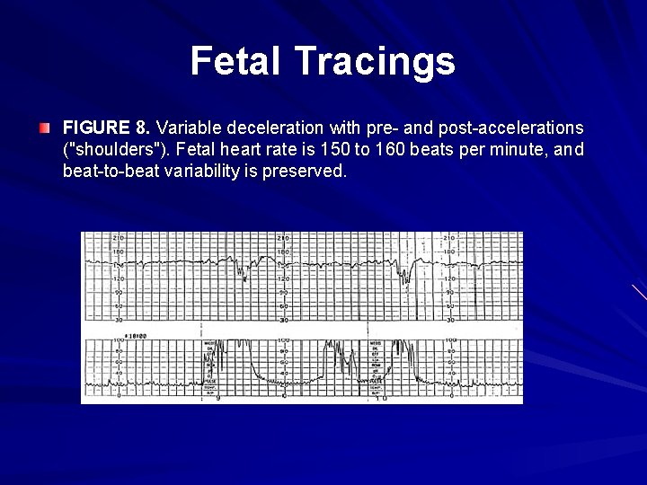 Fetal Tracings FIGURE 8. Variable deceleration with pre- and post-accelerations ("shoulders"). Fetal heart rate