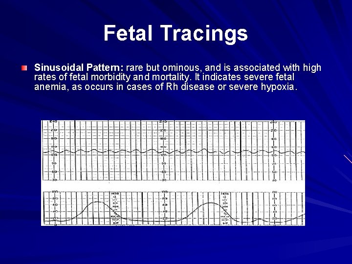 Fetal Tracings Sinusoidal Pattern: rare but ominous, and is associated with high rates of