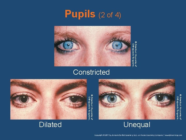 Pupils (2 of 4) © American Academy of Orthopaedic Surgeons. Constricted © American Academy