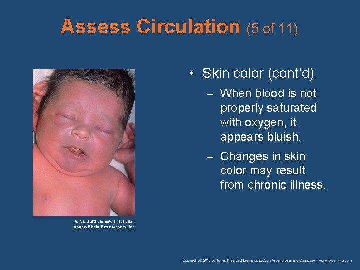 Assess Circulation (5 of 11) • Skin color (cont’d) – When blood is not
