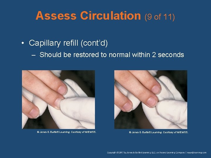 Assess Circulation (9 of 11) • Capillary refill (cont’d) – Should be restored to