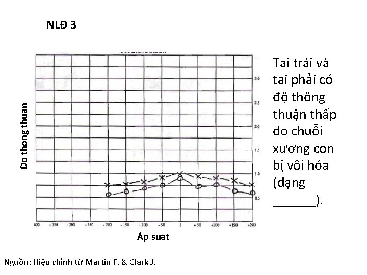 NLĐ 3 Do thong thuan Tai trái và tai phải có độ thông thuận