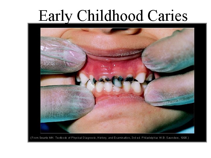 Early Childhood Caries (From Swartz MH. Textbook of Physical Diagnosis, History, and Examination, 3