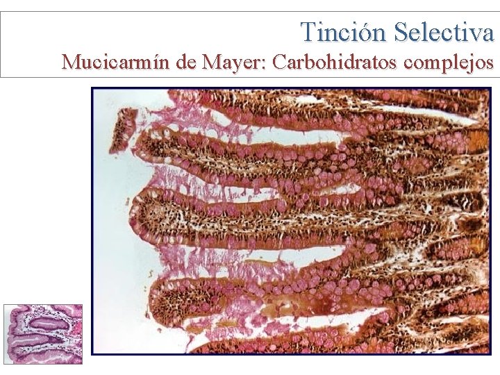 Tinción Selectiva Mucicarmín de Mayer: Carbohidratos complejos 