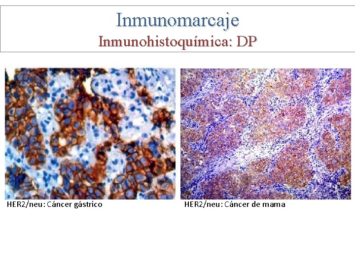 Inmunomarcaje Inmunohistoquímica: DP HER 2/neu: Cáncer gástrico HER 2/neu: Cáncer de mama 