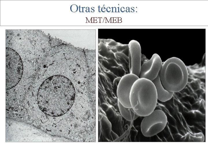 Otras técnicas: MET/MEB 