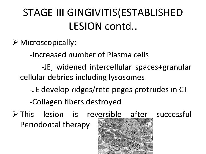 STAGE III GINGIVITIS(ESTABLISHED LESION contd. . Ø Microscopically: -Increased number of Plasma cells -JE,