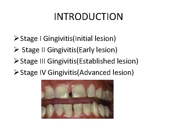 INTRODUCTION Ø Stage I Gingivitis(Initial lesion) Ø Stage II Gingivitis(Early lesion) Ø Stage III