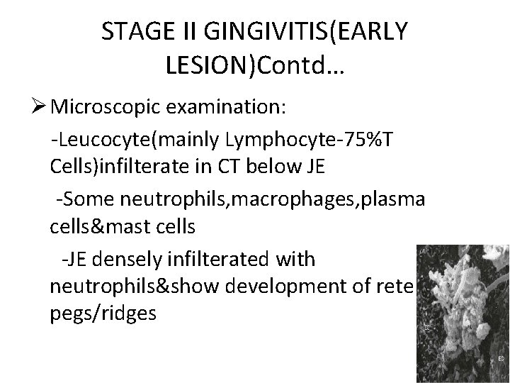 STAGE II GINGIVITIS(EARLY LESION)Contd… Ø Microscopic examination: -Leucocyte(mainly Lymphocyte-75%T Cells)infilterate in CT below JE