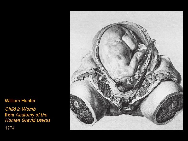 William Hunter Child in Womb from Anatomy of the Human Gravid Uterus 1774 