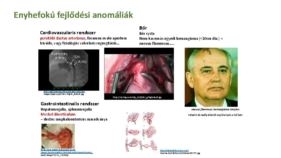 Enyhefokú fejlődési anomáliák Cardiovascularis rendszer Bőr persitáló ductus arteriosus, foramen ovale apertum triviális, vagy