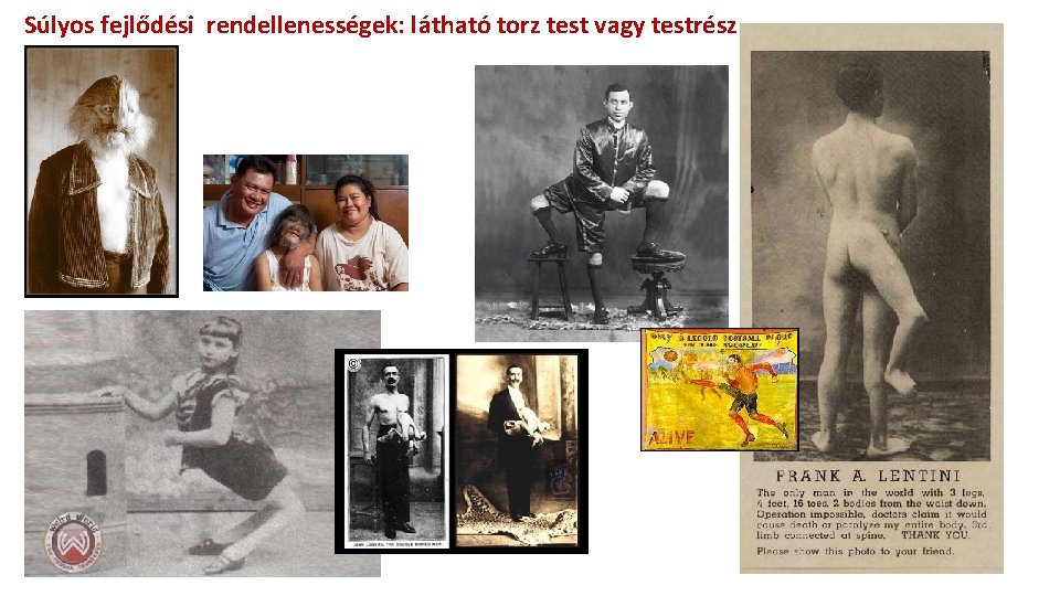 Súlyos fejlődési rendellenességek: látható torz test vagy testrész Súlyos fejlődési rendellenességek: látható torz test vagy testrész