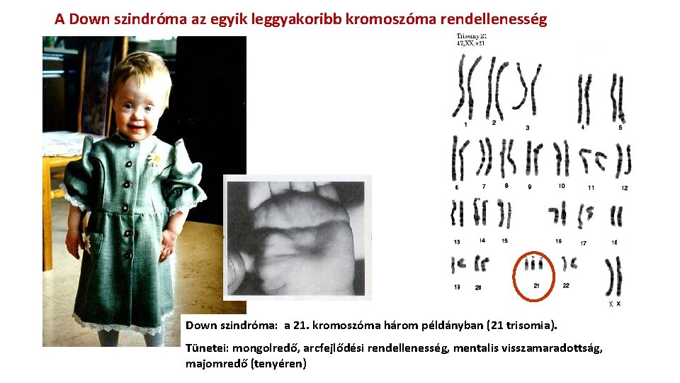 A Down szindróma az egyik leggyakoribb kromoszóma rendellenesség Down szindróma: a 21. kromoszóma három