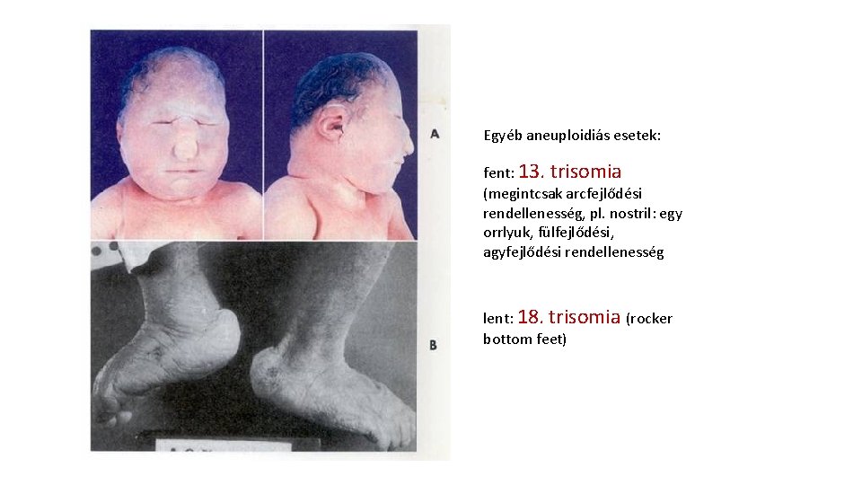 Egyéb aneuploidiás esetek: fent: 13. trisomia (megintcsak arcfejlődési rendellenesség, pl. nostril: egy orrlyuk, fülfejlődési,