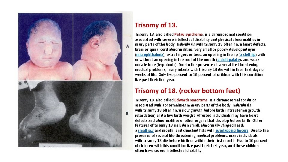 Trisomy of 13. Trisomy 13, also called Patau syndrome, is a chromosomal condition associated