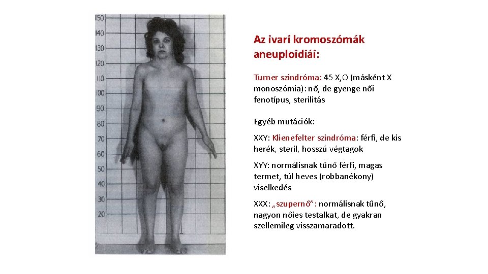 Az ivari kromoszómák aneuploidiái: Turner szindróma: 45 X, O (másként X monoszómia): nő, de