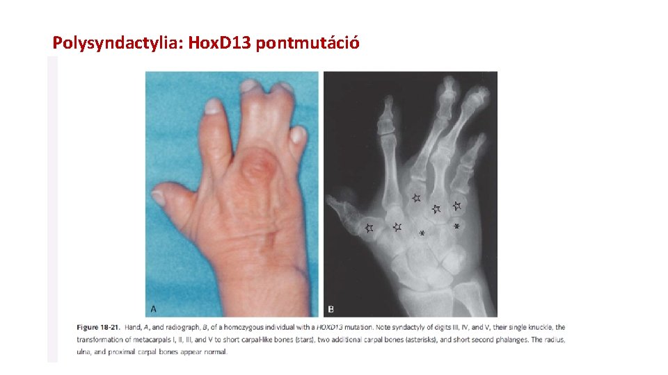 Polysyndactylia: Hox. D 13 pontmutáció Syndaktilia: az ujjak összeolvadása. Ebben a humán esetben a