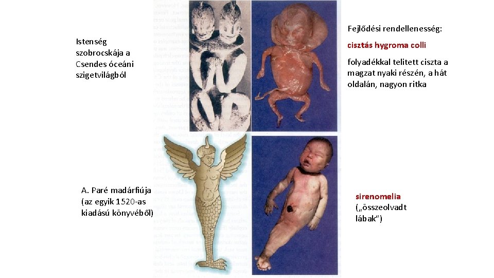 Fejlődési rendellenesség: Istenség szobrocskája a Csendes óceáni szigetvilágból A. Paré madárfiúja (az egyik 1520